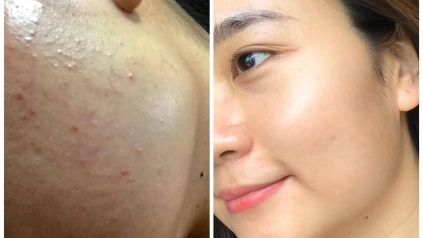 Nhà phân phối mỹ phẩm trị nám tại Điện Biên