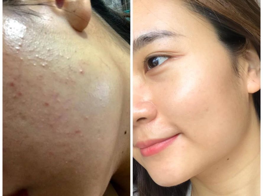 Nhà phân phối mỹ phẩm trị nám tại Điện Biên