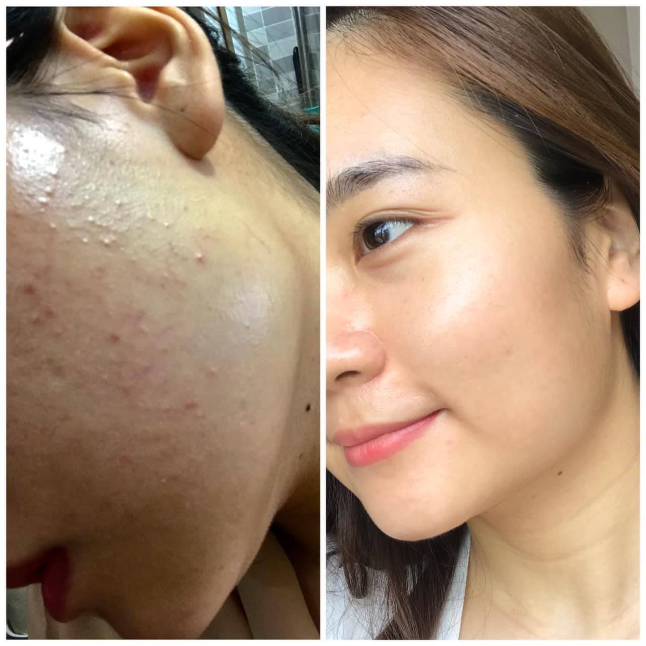 Nhà phân phối mỹ phẩm trị nám tại Điện Biên mong muốn tìm đối tác phân phối, CHIẾT KHẤU CỰC CAO !