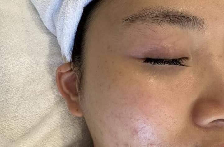 Kem trị mụn ban đêm có làm bong da không