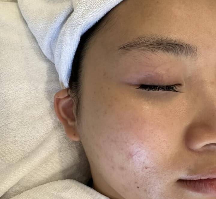 Kem trị mụn ban đêm có làm bong da không