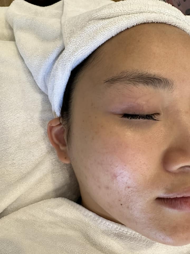 Kem trị mụn ban đêm có làm bong da không