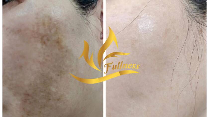 Lịch trình chi tiết 4 tuần đầu tiên cho người mới bắt đầu điều trị nám