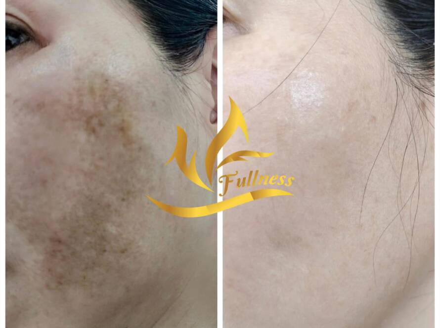 Lịch trình chi tiết 4 tuần đầu tiên cho người mới bắt đầu điều trị nám