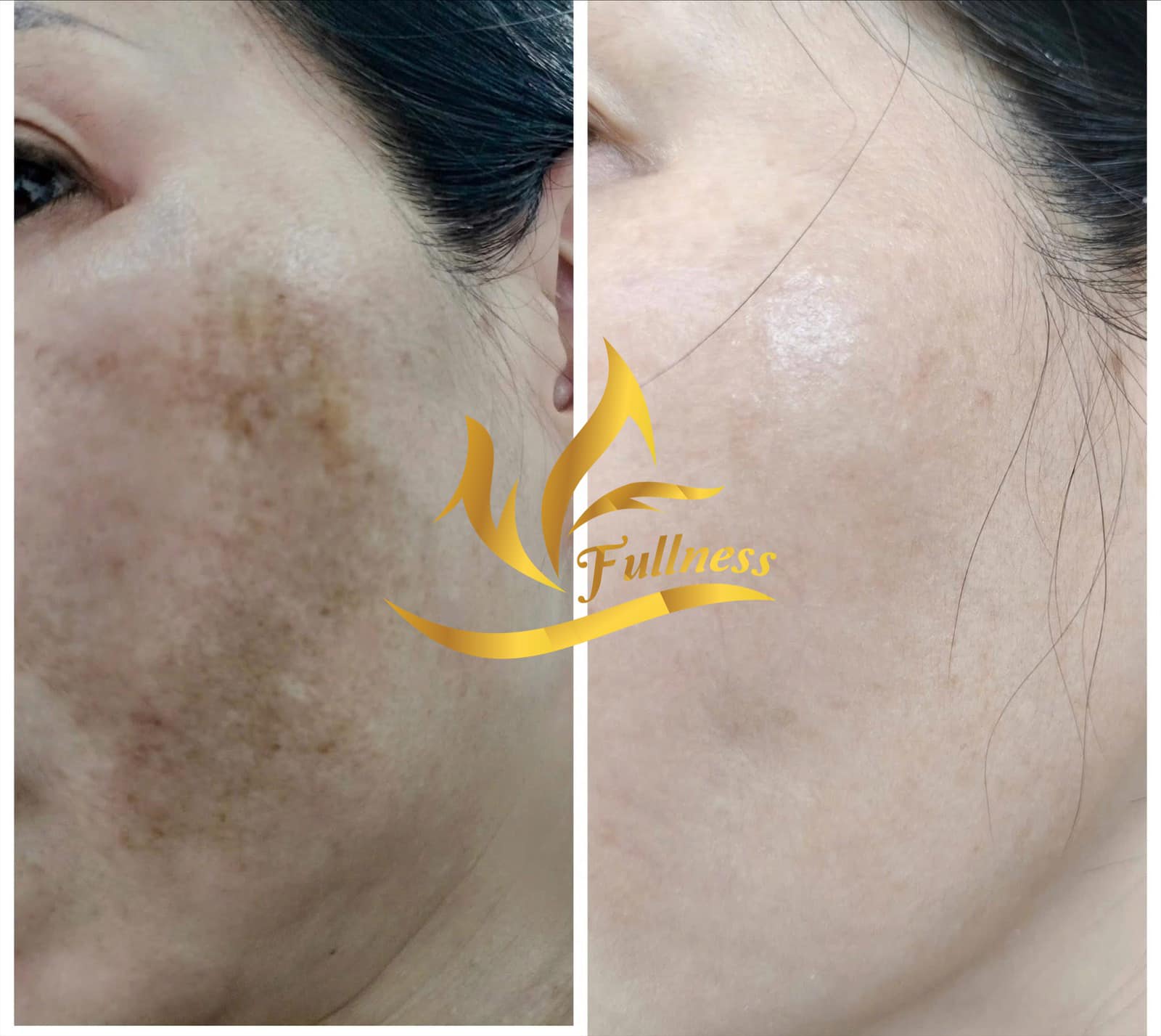Lịch trình chi tiết 4 tuần đầu tiên cho người mới bắt đầu điều trị nám