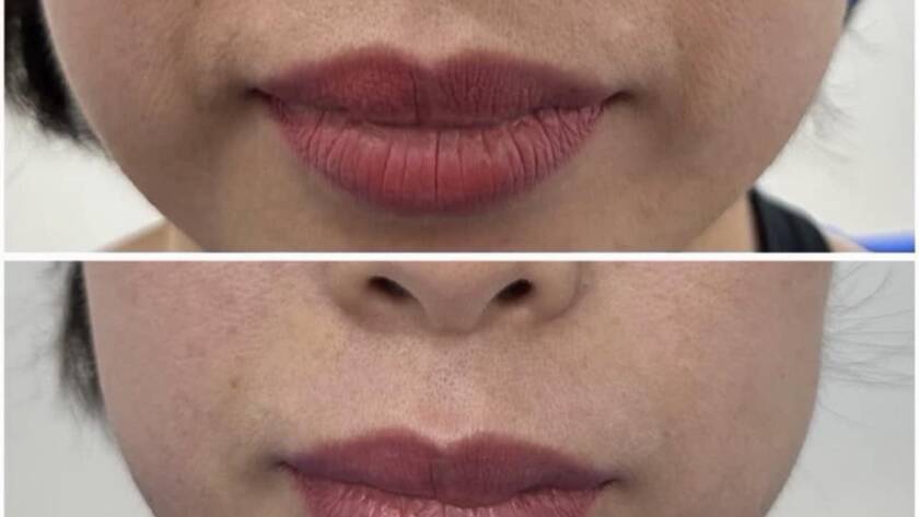 Laser trong điều trị nám