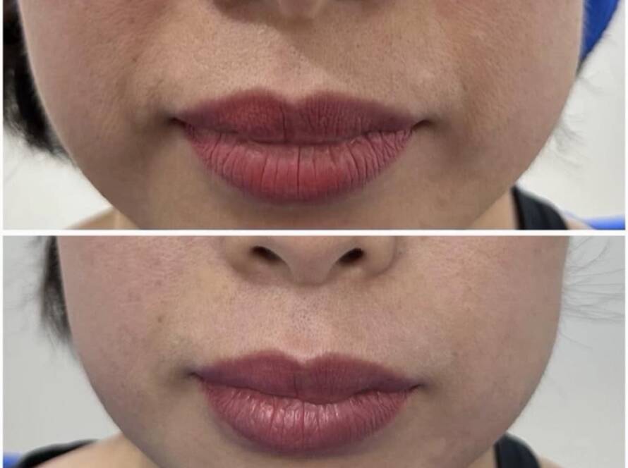 Laser trong điều trị nám