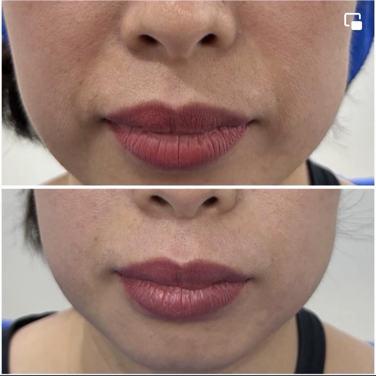 Laser rất hiệu quả trong điều trị nám nếu biết sử dụng đúng lúc và đúng cách