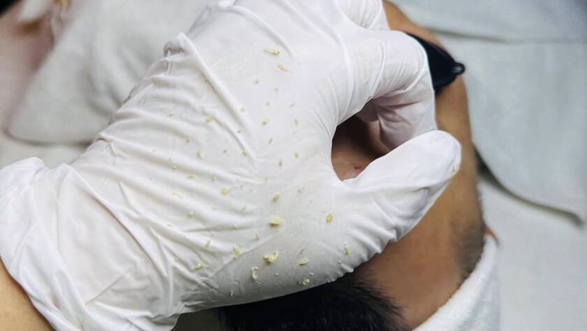 Khóa học điều trị da cơ bản: mụn và những điều bạn nên biết ?