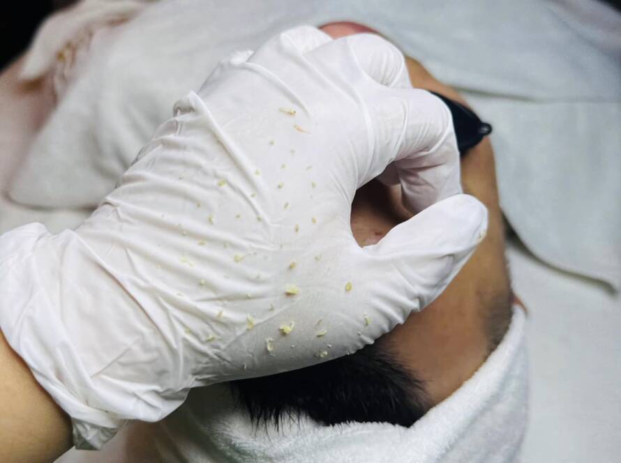 Khóa học điều trị da cơ bản: mụn và những điều bạn nên biết ?