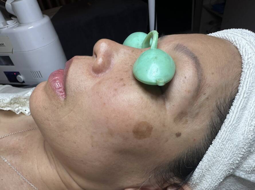 Khóa học điều trị da cơ bản: Nám và những điều bạn nên biết ?