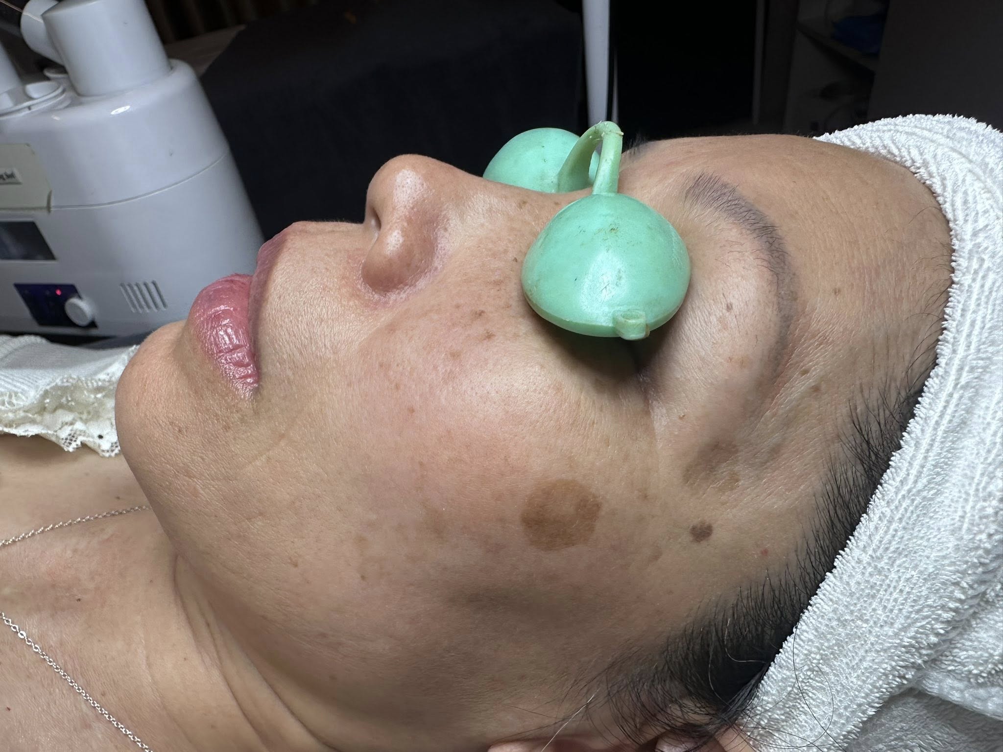 Khóa học điều trị da cơ bản: Nám và những điều bạn nên biết ?