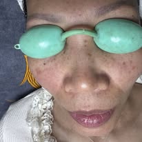 Khóa học điều trị da cơ bản: Hiểu về tàn nhang và những điều bạn nên biết ?