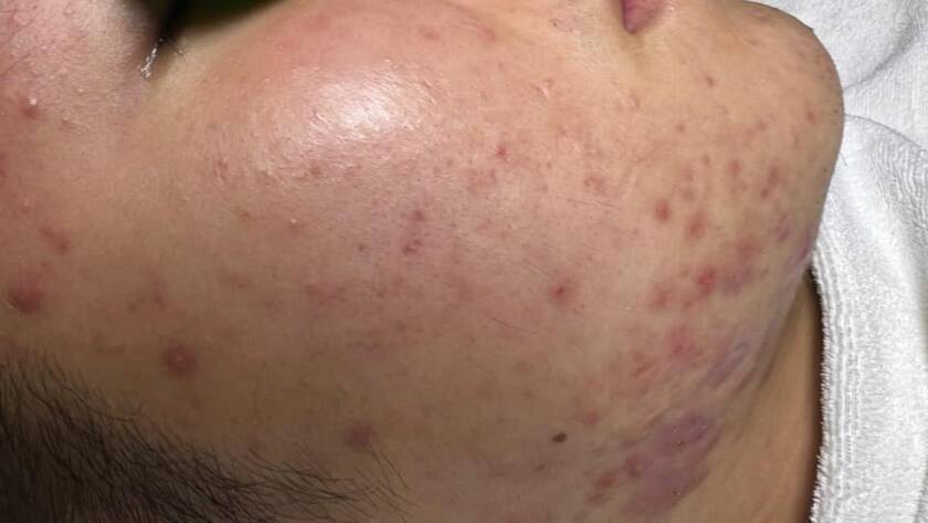 Khóa học tìm hiểu về căn bệnh trứng cá đỏ ở trên da, làm cách nào để kiểm soát chúng