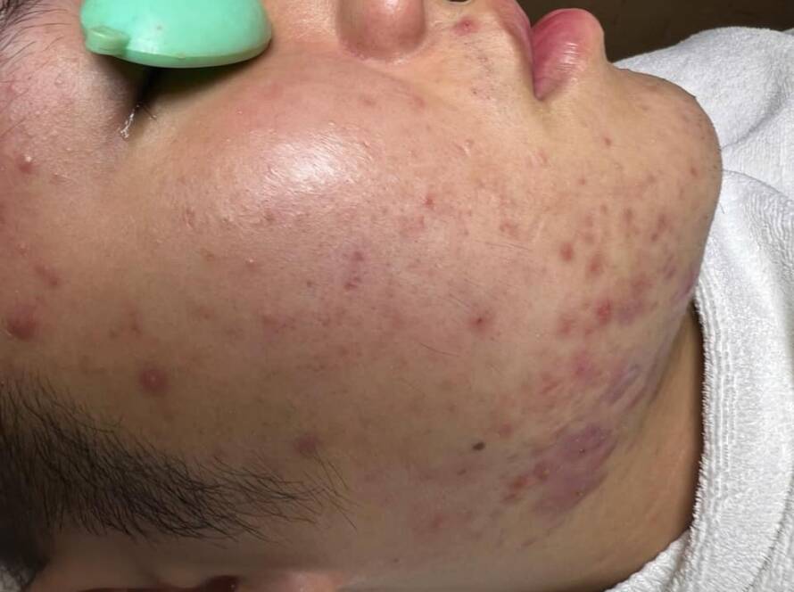 Khóa học tìm hiểu về căn bệnh trứng cá đỏ ở trên da, làm cách nào để kiểm soát chúng