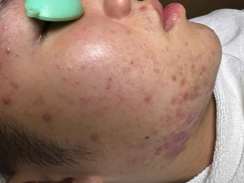 Khóa học tìm hiểu về căn bệnh trứng cá đỏ ở trên da, làm cách nào để kiểm soát chúng