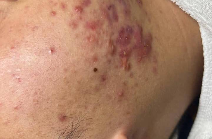 Hồi sinh làn da đầy mụn viêm