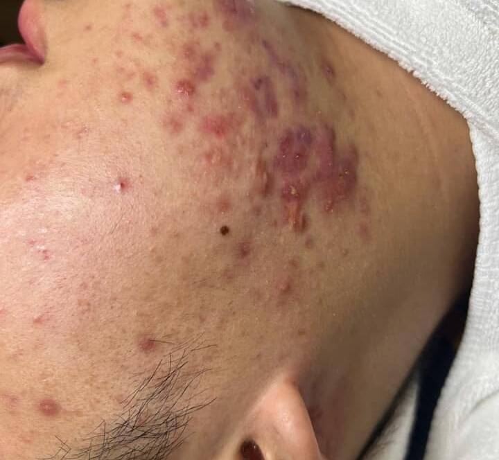 Hồi sinh làn da đầy mụn viêm