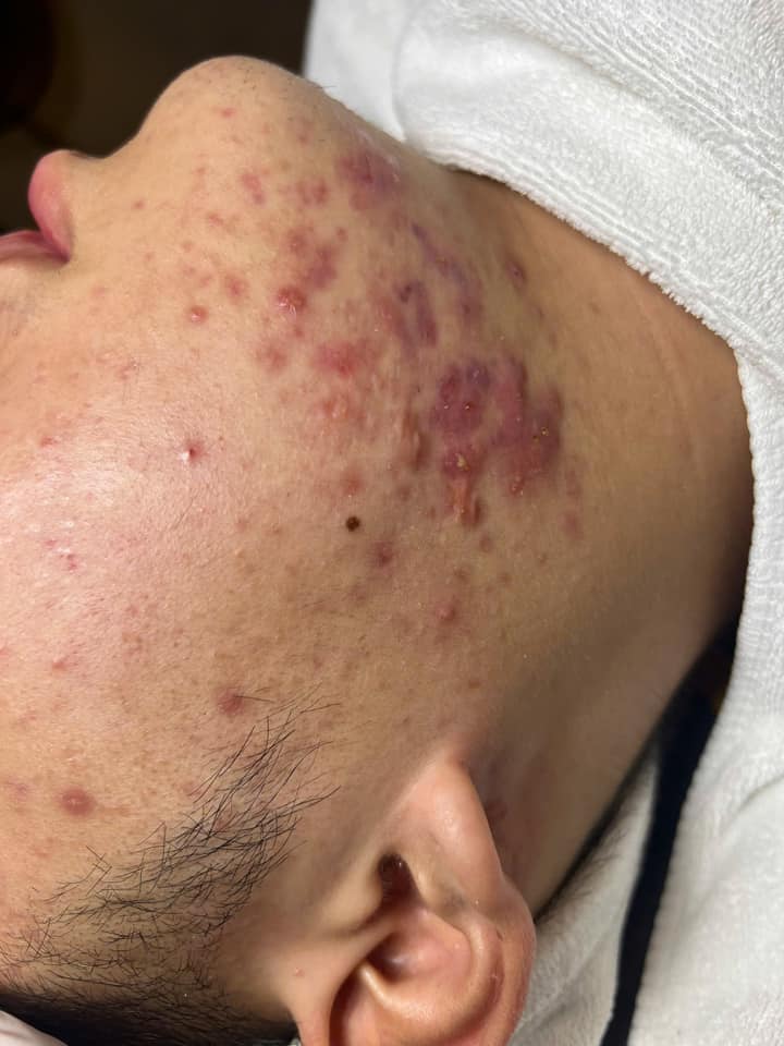 Hồi sinh làn da đầy mụn viêm