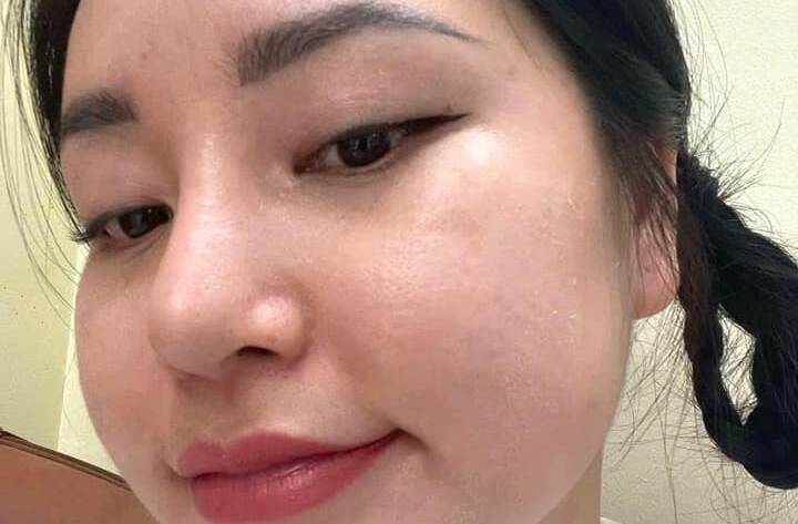 Cơ chế làm đầy sẹo rỗ bằng máy CNC