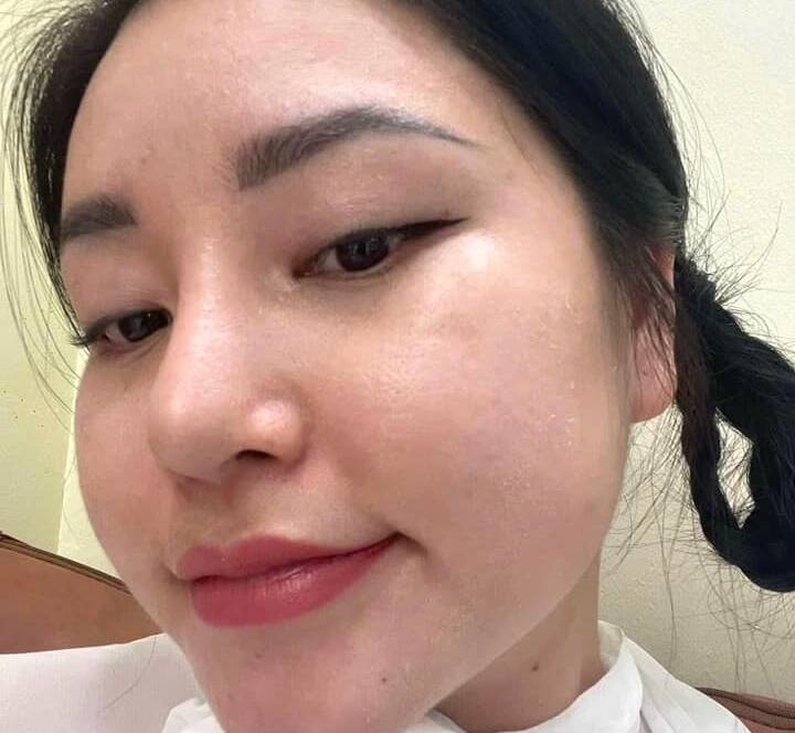 Cơ chế làm đầy sẹo rỗ bằng máy CNC