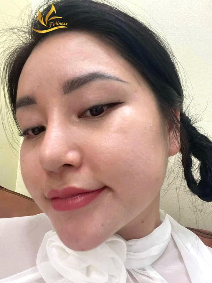 Cơ chế làm đầy sẹo rỗ bằng máy CNC