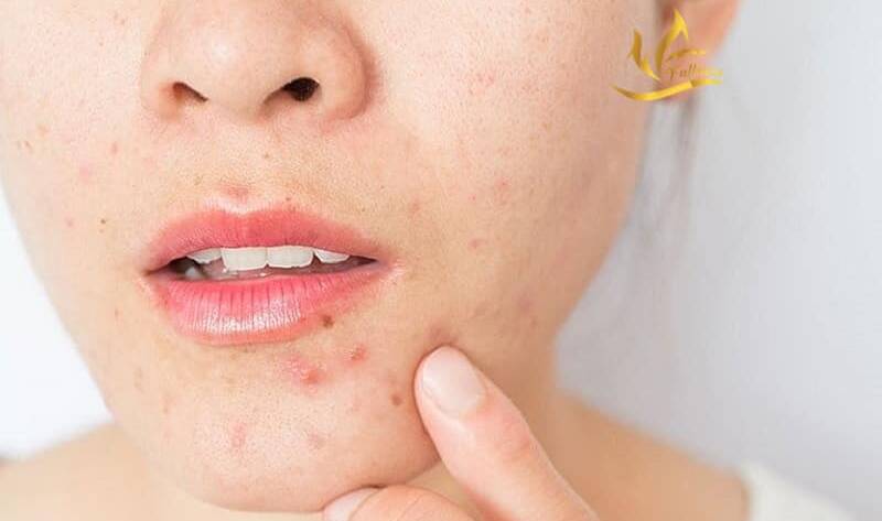 5 điều sẽ xảy ra nếu bạn không rửa mặt vào buổi tối