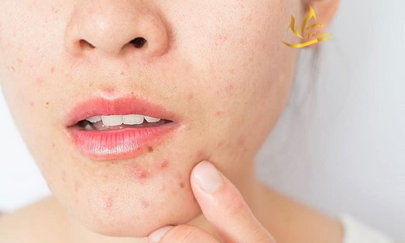 5 điều sẽ xảy ra nếu bạn không rửa mặt vào buổi tối