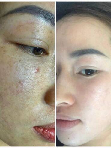 Trị nám hiệu quả bền vững