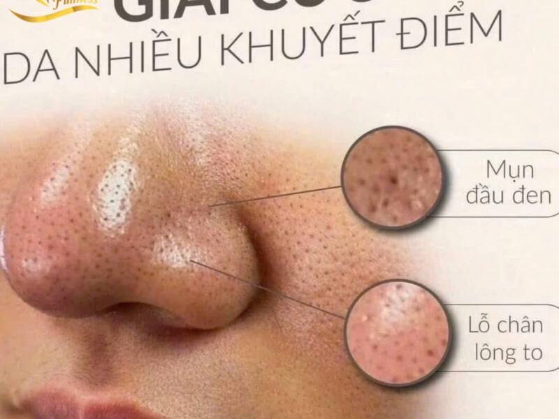 Hút dầu cho da mặt tại Spa sao cho đúng, cần có những lưu ý gì ?