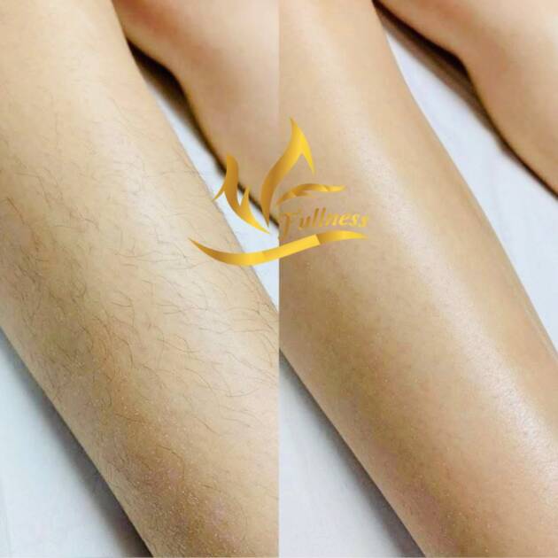 Công nghệ triệt lông lạnh thế hệ mới